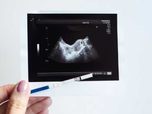 Fertility Treatment For High FSH – Getting Pregnant With High FSH Levels